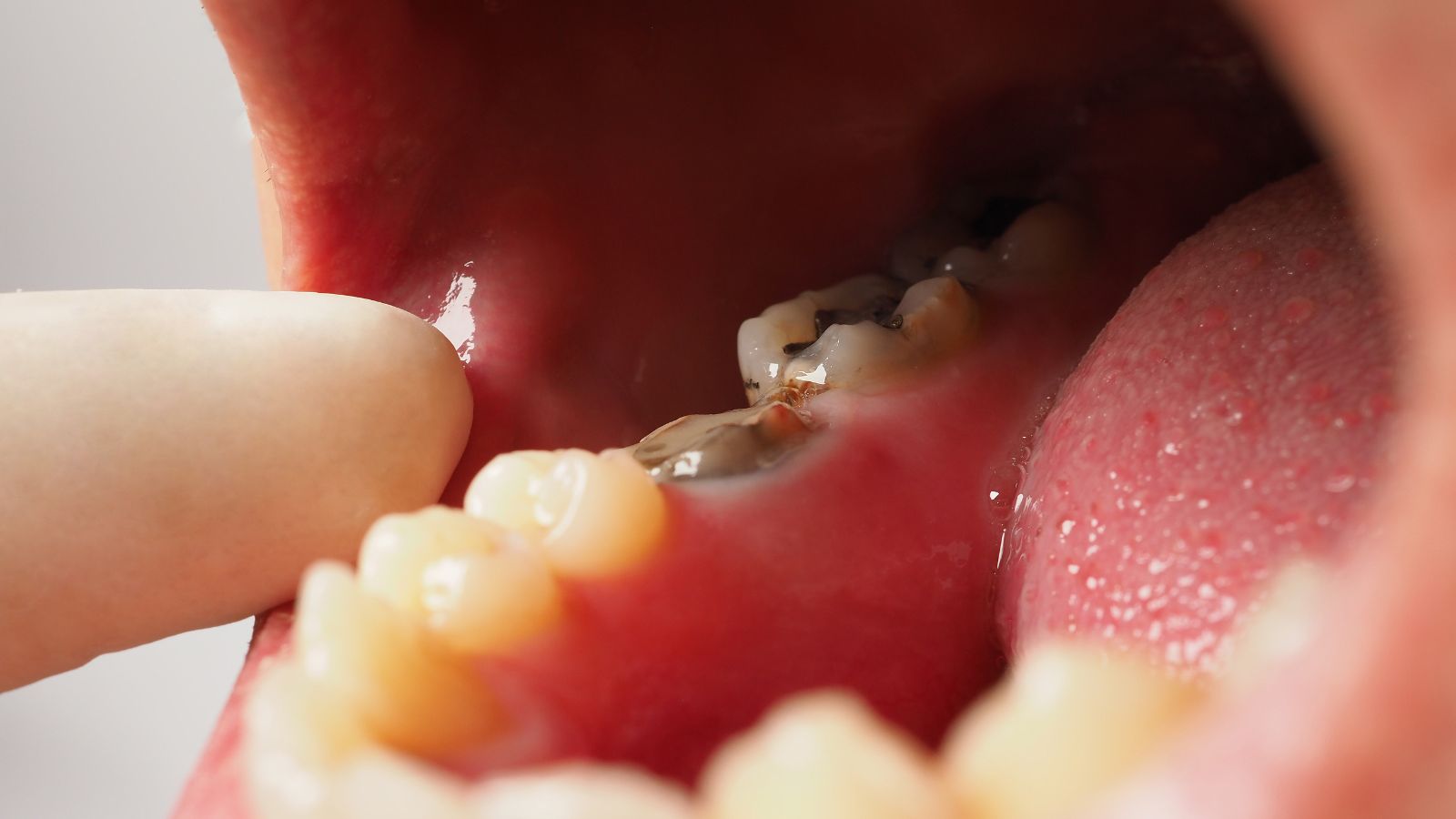 歯 が 痛い ロキソニン 効か ない 知恵袋